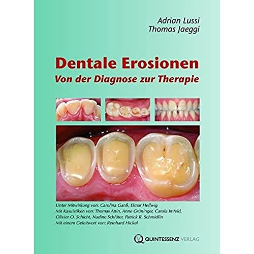 Dentale Erosionen: Von der Diagnose zur Therapie von Quintessenz Verlag