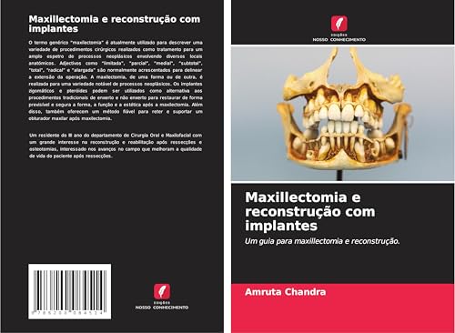 Maxillectomia e reconstrução com implantes: Um guia para maxillectomia e reconstrução. von Edições Nosso Conhecimento