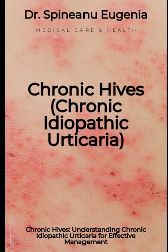 Chronic Hives: Understanding Chronic Idiopathic Urticaria for Effective Management von Independently published