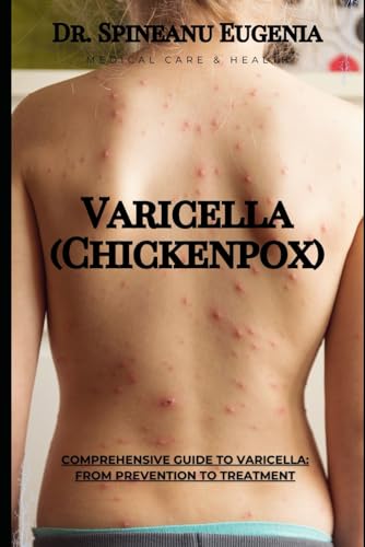 Comprehensive Guide to Varicella: From Prevention to Treatment (Medical care and health) von Independently published