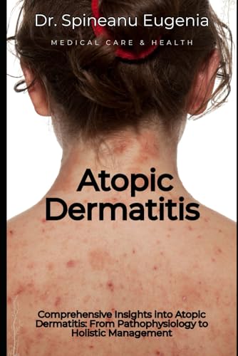 Comprehensive Insights into Atopic Dermatitis: From Pathophysiology to Holistic Management (Medical care and health) von Independently published