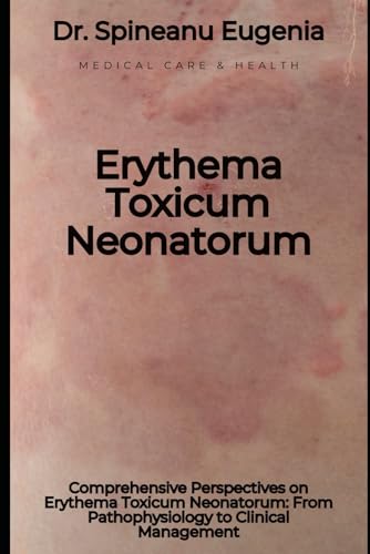 Comprehensive Perspectives on Erythema Toxicum Neonatorum: From Pathophysiology to Clinical Management von Independently published