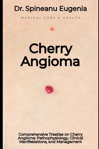 Comprehensive Treatise on Cherry Angioma: Pathophysiology, Clinical Manifestations, and Management von Independently published