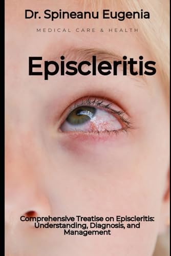 Comprehensive Treatise on Episcleritis: Understanding, Diagnosis, and Management von Independently published