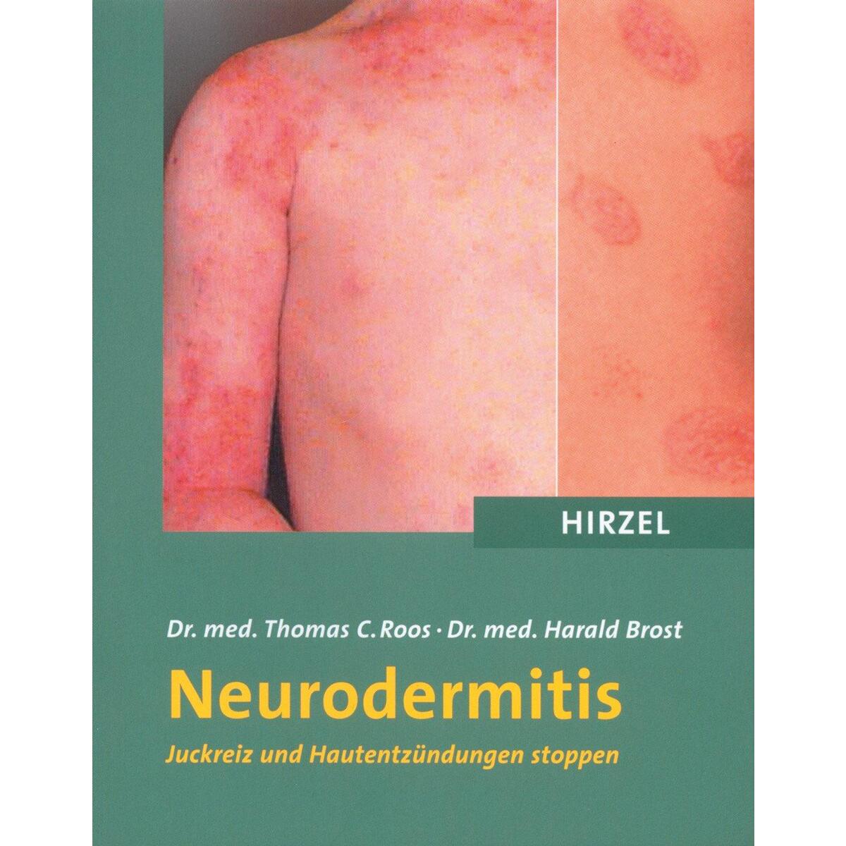 Neurodermitis von Hirzel S. Verlag